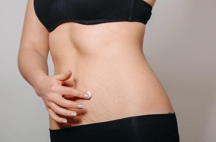 The Cause of Stretch Mark Signs in Women