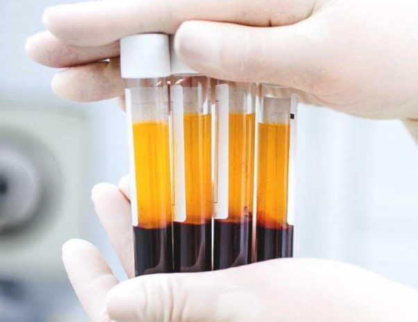 Benefits of PRP Treatments